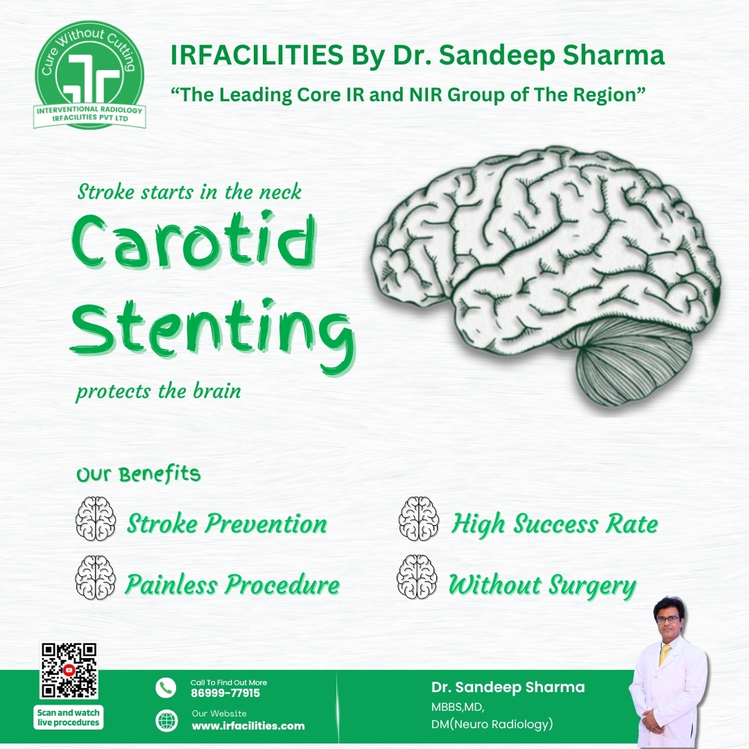 Benefits of the Carotid Artery Stenting Procedure